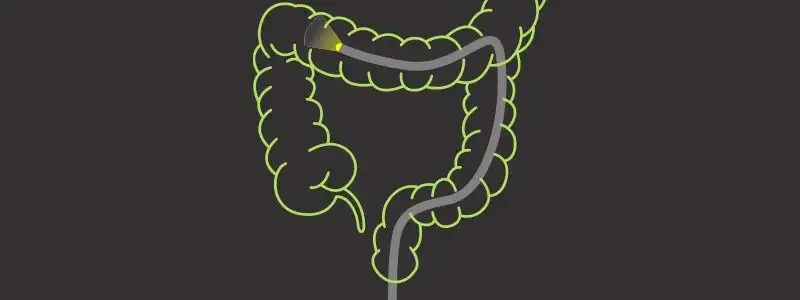 Colonoscopy: What's the Right Age to Begin?