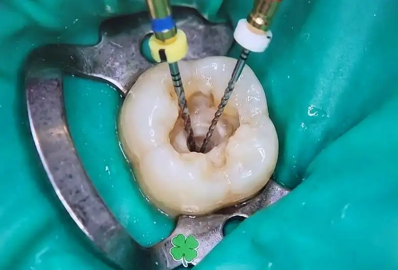 Root Canal Treatment in Turkey | Endodontics