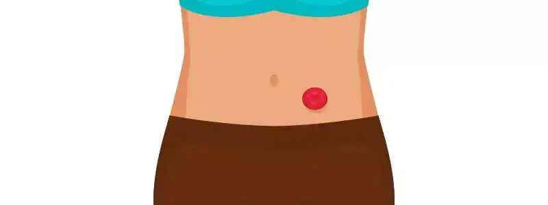 Why Is a Stoma Necessary? Colostomy vs Ileostomy Explained